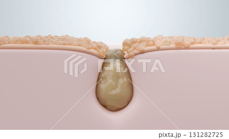 毛穴の黒ずみとオイリー肌の原因を示す断面図 角栓の酸化 毛穴の黒ずみとオイリー肌の原因を示す断面図 角栓の酸化 131282725