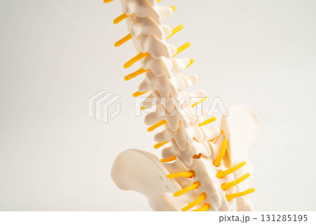 Spinal nerve and bone, Lumbar spine displaced herniated disc fragment, Model for treatment medical in the orthopedic department. 131285195
