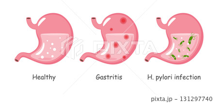 Stomach with medical condition including healthy, gastritis, Helicobacter pylori infection . Cartoon illustration . Isolated white background . Vector . 131297740