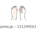 炎症を起こしていて痛みを感じている外反母趾の人の両足のイラスト/片足レントゲン/図解 131299561