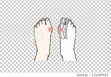 炎症を起こしていて痛みを感じている外反母趾の人の両足のイラスト/片足レントゲン/図解 131299561