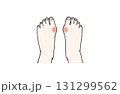 炎症を起こしていて痛みを感じている外反母趾の人の両足のイラスト 131299562