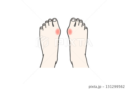 炎症を起こしていて痛みを感じている外反母趾の人の両足のイラスト 131299562