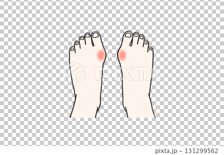 炎症を起こしていて痛みを感じている外反母趾の人の両足のイラスト 131299562