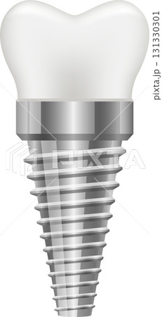 A shiny, silver dental implant featuring screw threads and a white tooth cap, standing alone. A shiny, silver dental implant featuring screw threads and a white tooth cap, standing alone. 131330301