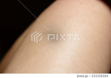 A closeup view of a persons arm that has a noticeable black spot on it 131338164