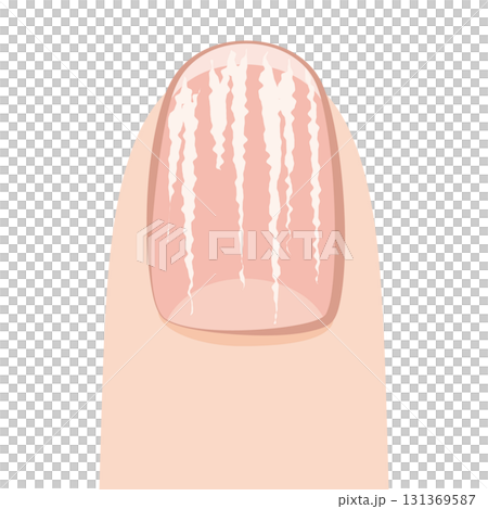 扁平苔指甲 131369587