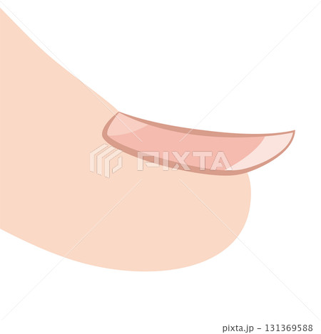 スプーン爪 スプーン爪 131369588