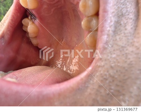 open mouth of a man with the place of pulled out small molar tooth, healing of a wound in the place of the tooth. open mouth of a man with the place of pulled out small molar tooth, healing of a wound in the place of the tooth. 131369677