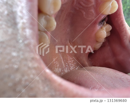 open mouth of a man with the place of pulled out small molar tooth, healing of a wound in the place of the tooth. 131369680