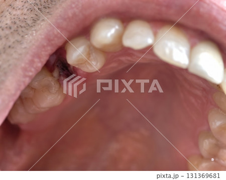 open mouth of a man with the place of pulled out small molar tooth, healing of a wound in the place of the tooth. open mouth of a man with the place of pulled out small molar tooth, healing of a wound in the place of the tooth. 131369681