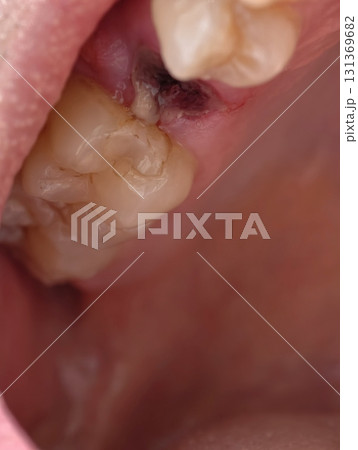 open mouth of a man with the place of pulled out small molar tooth, healing of a wound in the place of the tooth. 131369682