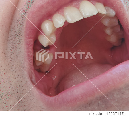open mouth of a man with the place of pulled out small molar tooth, healing of a wound in the place of the tooth. open mouth of a man with the place of pulled out small molar tooth, healing of a wound in the place of the tooth. 131371374