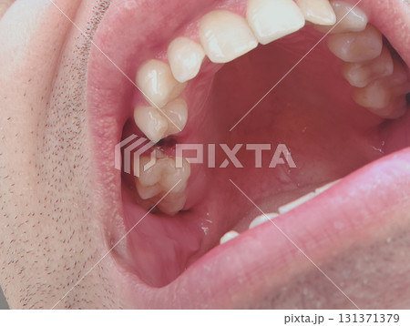 open mouth of a man with the place of pulled out small molar tooth, healing of a wound in the place of the tooth. open mouth of a man with the place of pulled out small molar tooth, healing of a wound in the place of the tooth. 131371379