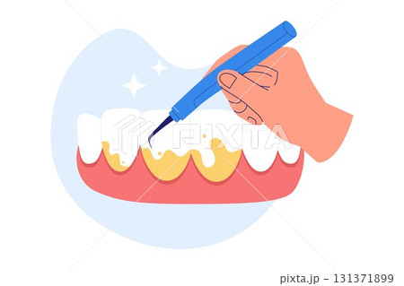 Illustration of Plaque Removal and Dental Scaling Illustration of Plaque Removal and Dental Scaling 131371899