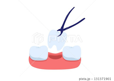 Illustration of Tooth Extraction Procedure Illustration of Tooth Extraction Procedure 131371901