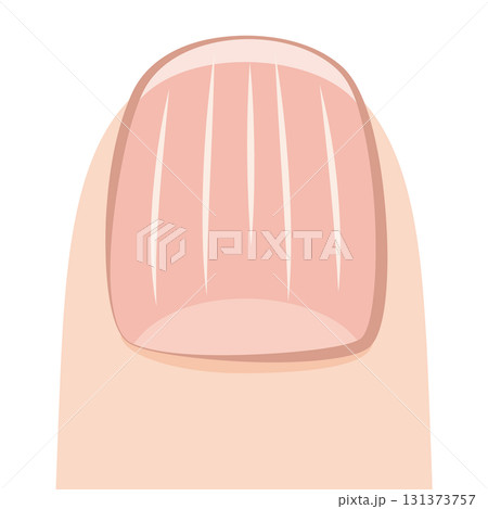 縦筋の入った爪 131373757