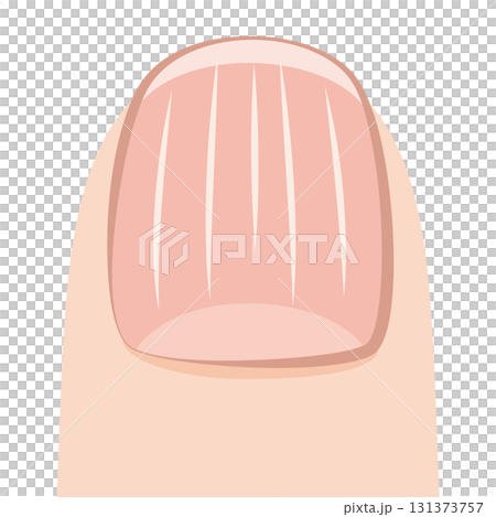 縦筋の入った爪 131373757