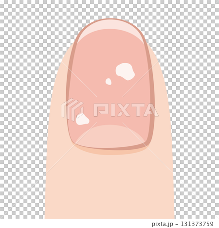 指甲有白點 131373759