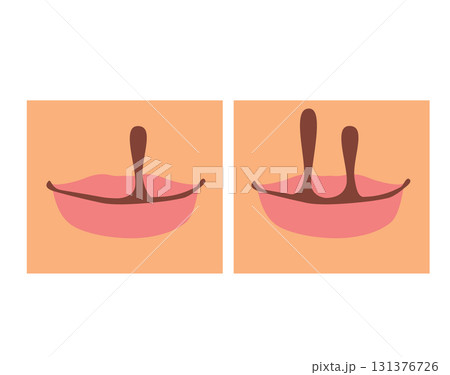 Cartoon Illustration Of Cleft Lip And Palate Infographic On Skin Background Cartoon Illustration Of Cleft Lip And Palate Infographic On Skin Background 131376726