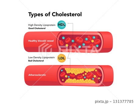 Types of cholesterol comparison with HDL and LDL stock illustration Types of cholesterol comparison with HDL and LDL stock illustration 131377785