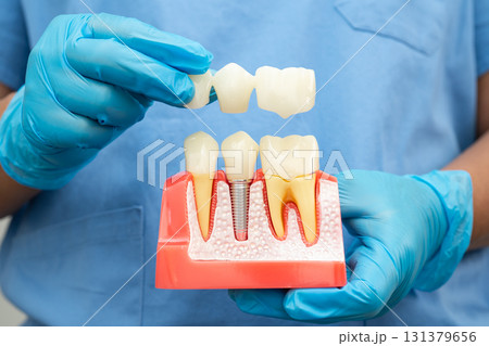 Dental implant, artificial tooth roots into jaw, root canal of dental treatment, gum disease, teeth model for dentist studying about dentistry. Dental implant, artificial tooth roots into jaw, root canal of dental treatment, gum disease, teeth model for dentist studying about dentistry. 131379656