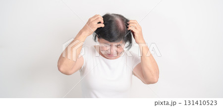 Elderly woman having itchy Scalp and Head hair, Dandruff, Dry Scalp, Skin Allergy Seborrheic dermatitis. Dermatology, Leprosy day, Systemic lupus erythematosus, SLE, Psoriasis and Atopic Eczema rash Elderly woman having itchy Scalp and Head hair, Dandruff, Dry Scalp, Skin Allergy Seborrheic dermatitis. Dermatology, Leprosy day, Systemic lupus erythematosus, SLE, Psoriasis and Atopic Eczema rash 131410523
