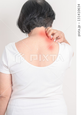 Elderly woman itching Neck and body scratching for Skin Allergy from insect bite and food dermatitis. Dermatology, Leprosy day, Systemic lupus erythematosus, Psoriasis, Urticaria and rash Eczema 131410634
