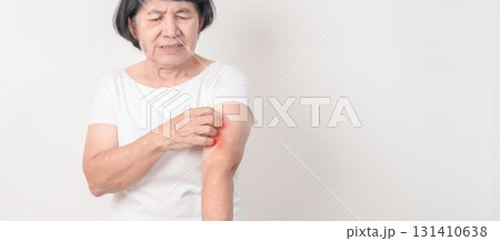 Elderly woman itching arm and body scratching for Skin Allergy from insect bite and food dermatitis. Dermatology, Leprosy day, Systemic lupus erythematosus, Psoriasis, Urticaria and rash Eczema 131410638