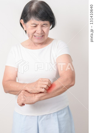 Elderly woman itching arm and body scratching for Skin Allergy from insect bite and food dermatitis. Dermatology, Leprosy day, Systemic lupus erythematosus, Psoriasis, Urticaria and rash Eczema Elderly woman itching arm and body scratching for Skin Allergy from insect bite and food dermatitis. Dermatology, Leprosy day, Systemic lupus erythematosus, Psoriasis, Urticaria and rash Eczema 131410640