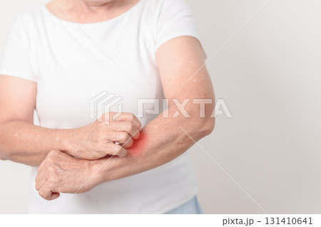 Elderly woman itching arm and body scratching for Skin Allergy from insect bite and food dermatitis. Dermatology, Leprosy day, Systemic lupus erythematosus, Psoriasis, Urticaria and rash Eczema 131410641