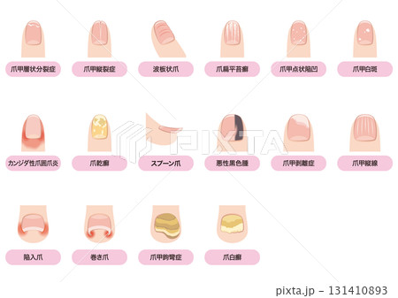爪の病気一覧 131410893