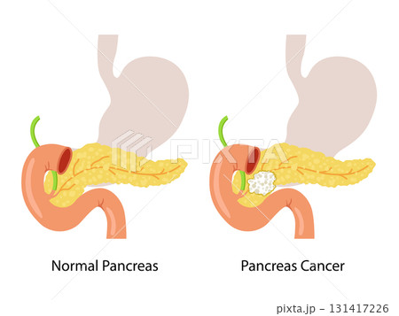 Pancreas or Pancreatic Cancer with organs and Tumors. Cancerous cells for education material, brochure, website, medical portal, atlas, textbook, presentation. Oncology, disease, medical, healthcare c Pancreas or Pancreatic Cancer with organs and Tumors. Cancerous cells for education material, brochure, website, medical portal, atlas, textbook, presentation. Oncology, disease, medical, healthcare c 131417226