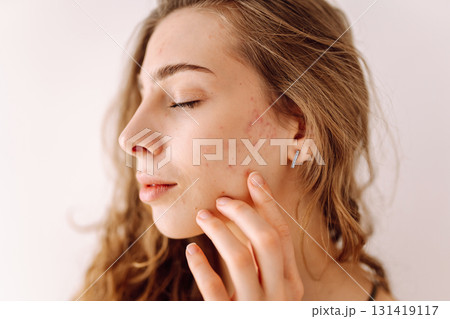Portrait of a beautiful young woman with inflammations on the skin of her face. Acne disease. Portrait of a beautiful young woman with inflammations on the skin of her face. Acne disease. 131419117