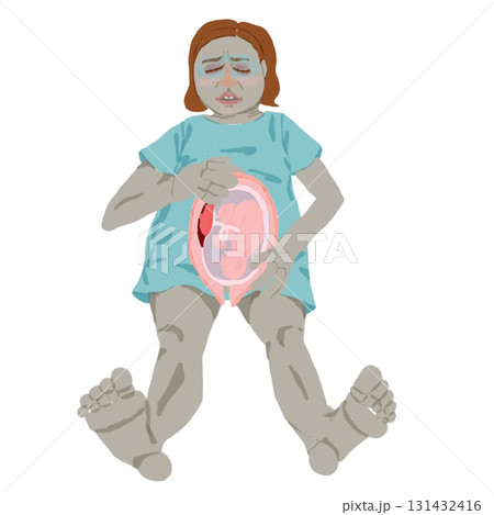 常位胎盤早期剥離イラスト(妊婦・胎児断面図) 常位胎盤早期剥離イラスト(妊婦・胎児断面図) 131432416