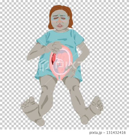 常位胎盤早期剥離イラスト(妊婦・胎児断面図) 常位胎盤早期剥離イラスト(妊婦・胎児断面図) 131432416