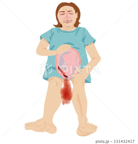 前置胎盤による出血イラスト(妊婦・胎児断面図) 前置胎盤による出血イラスト(妊婦・胎児断面図) 131432417