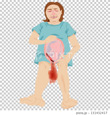 前置胎盤による出血イラスト(妊婦・胎児断面図) 前置胎盤による出血イラスト(妊婦・胎児断面図) 131432417