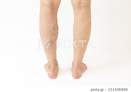 下肢静脈瘤の脚 下肢静脈瘤の脚 131436998