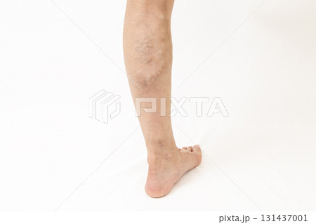 下肢静脈瘤の脚 下肢静脈瘤の脚 131437001