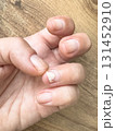hand with damaged nail separates from flesh 131452910