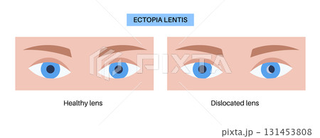 Ectopia lentis disease Ectopia lentis disease 131453808