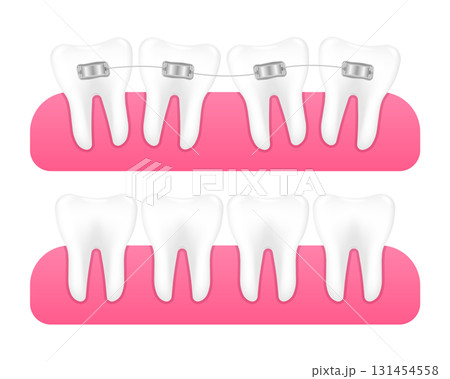 Braces on teeth. Alignment of teeth and bite correction with the help of braces system. Orthodontics braces. Dental care concept. Vector illustration. 131454558
