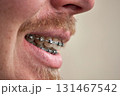 Smile with dental braces, side view, closeup. Man with red mustache and beard 131467542