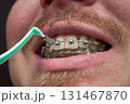 Adult man brushes his teeth with braces by interdental brush 131467870