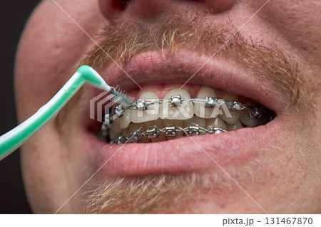 Adult man brushes his teeth with braces by interdental brush Adult man brushes his teeth with braces by interdental brush 131467870