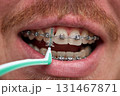 Adult man brushes his teeth with braces by interdental brush 131467871