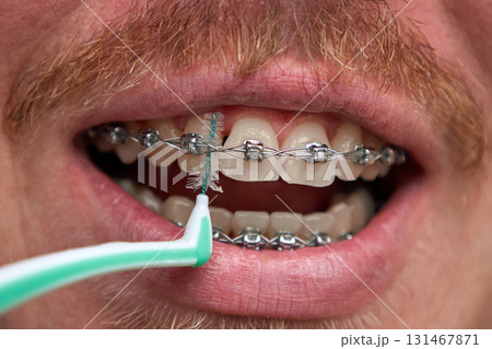 Adult man brushes his teeth with braces by interdental brush 131467871