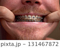 Adult man with red mustache and beard shows teeth with braces 131467872