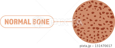 Illustration of healthy bone matter and cell structure. This is a diagram to explain. 131470017